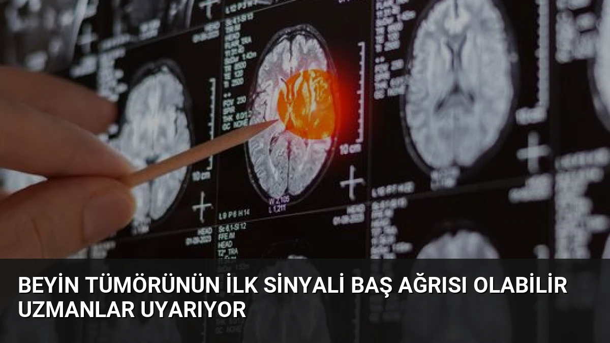 Beyin Tümörünün İlk Sinyali Baş Ağrısı Olabilir Uzmanlar Uyarıyor
