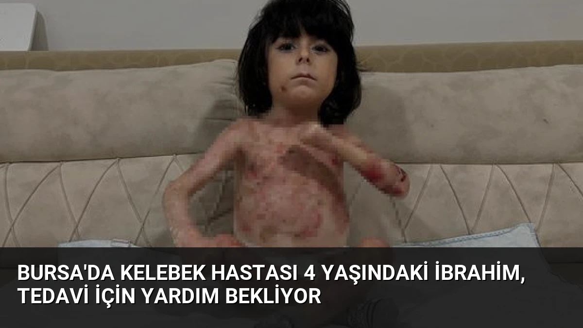Bursa’da Kelebek Hastası 4 Yaşındaki İbrahim, Tedavi İçin Yardım Bekliyor