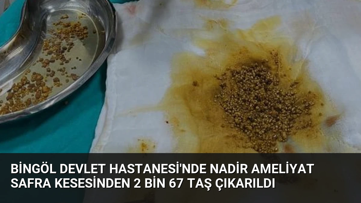 Bingöl Devlet Hastanesi’nde Nadir Ameliyat Safra Kesesinden 2 Bin 67 Taş Çıkarıldı