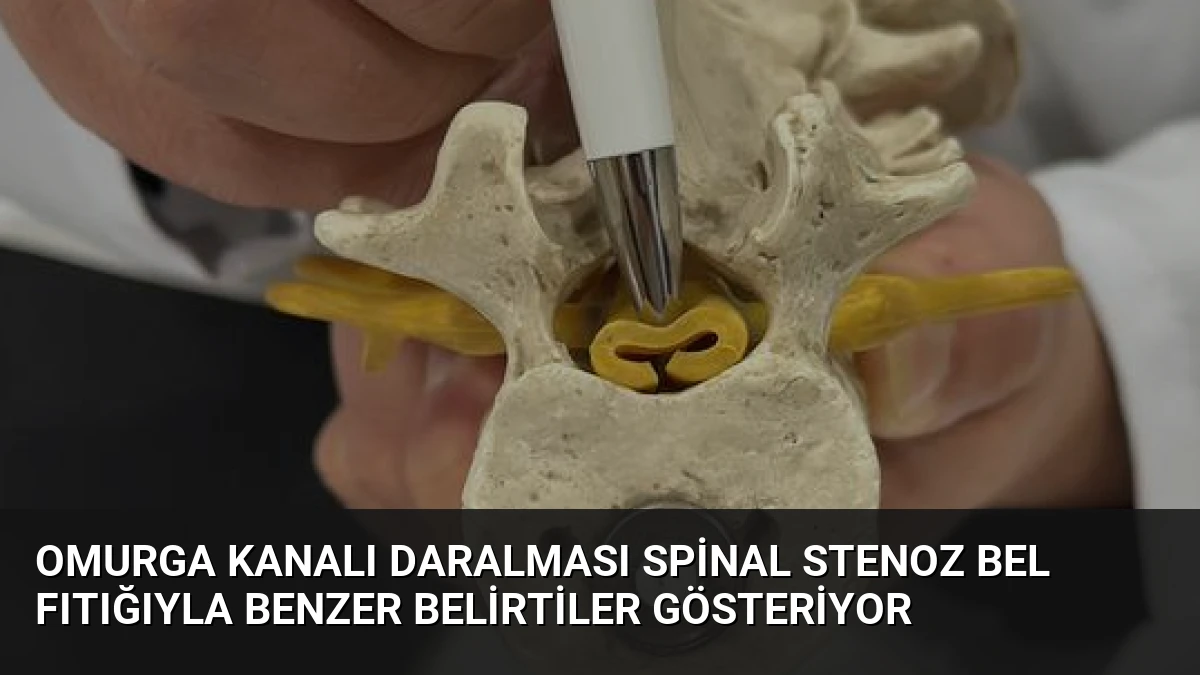 Omurga Kanalı Daralması Spinal Stenoz Bel Fıtığıyla Benzer Belirtiler Gösteriyor