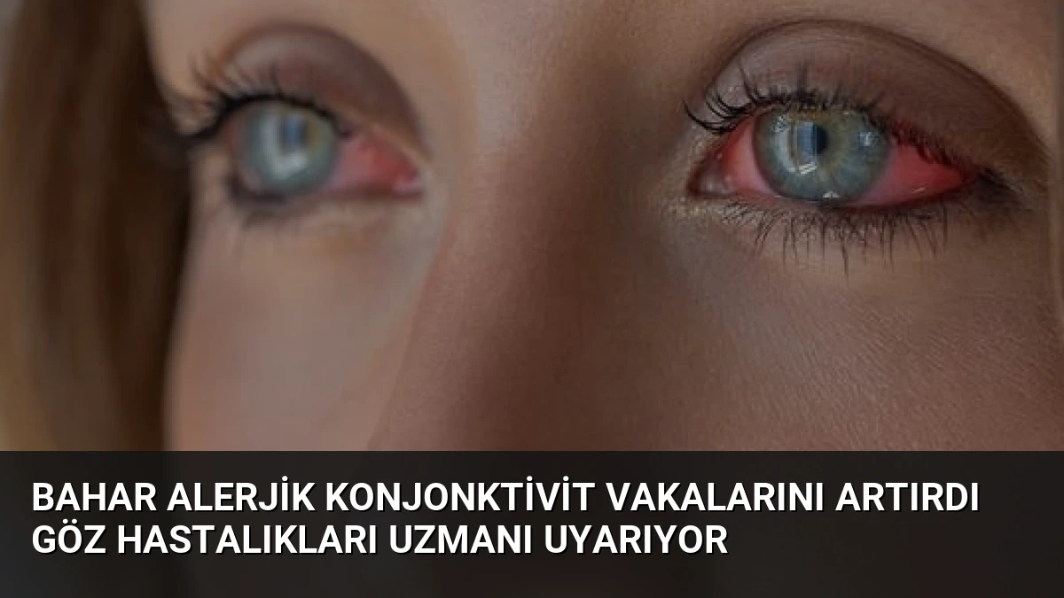 Bahar Alerjik Konjonktivit Vakalarını Artırdı Göz Hastalıkları Uzmanı Uyarıyor