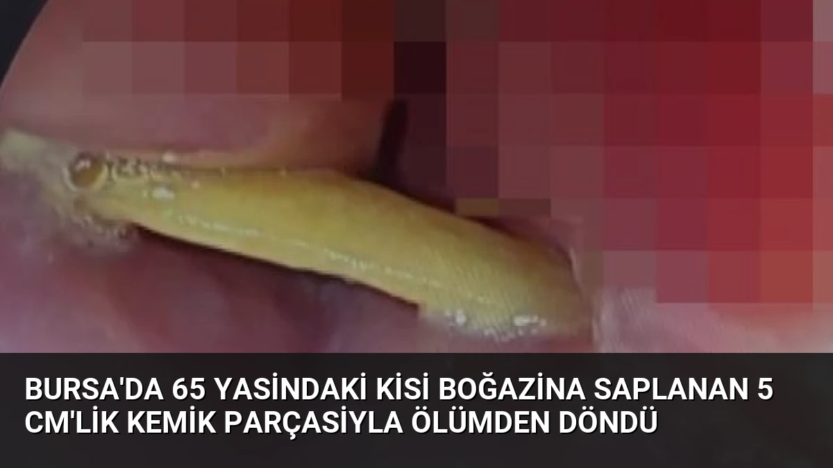 Bursa’da 65 Yasindaki Kisi Boğazina Saplanan 5 Cm’lik Kemik Parçasiyla Ölümden Döndü