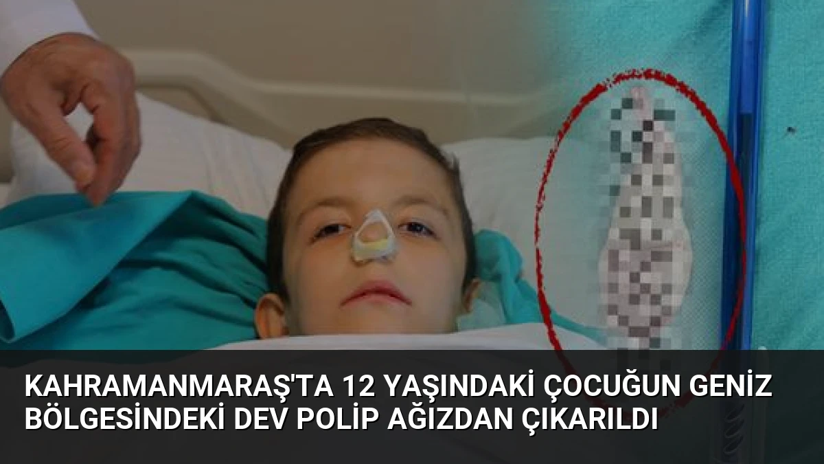 Kahramanmaraş’ta 12 Yaşındaki Çocuğun Geniz Bölgesindeki Dev Polip Ağızdan Çıkarıldı